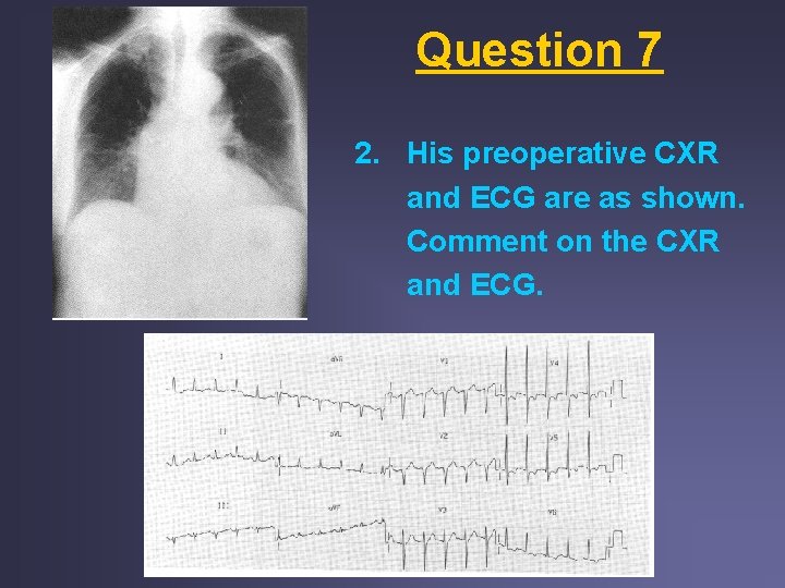 Question 7 2. His preoperative CXR and ECG are as shown. Comment on the Question 7 2. His preoperative CXR and ECG are as shown. Comment on the