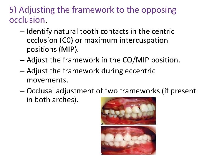 5) Adjusting the framework to the opposing occlusion. – Identify natural tooth contacts in