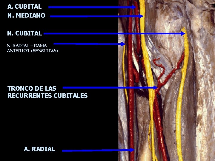 A. CUBITAL N. MEDIANO N. CUBITAL N. RADIAL – RAMA ANTERIOR (SENSITIVA) TRONCO DE