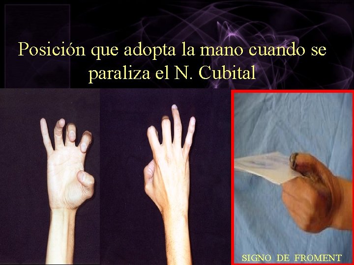 Posición que adopta la mano cuando se paraliza el N. Cubital SIGNO DE FROMENT