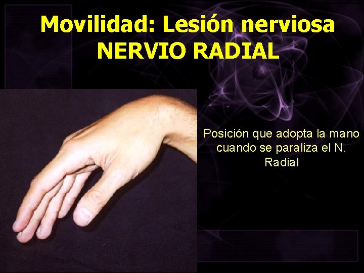 Movilidad: Lesión nerviosa NERVIO RADIAL Posición que adopta la mano cuando se paraliza el