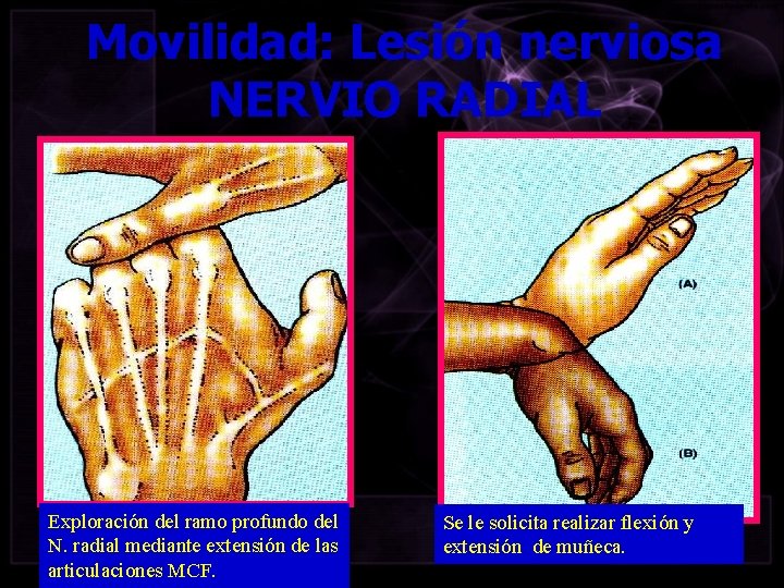 Movilidad: Lesión nerviosa NERVIO RADIAL Exploración del ramo profundo del N. radial mediante extensión