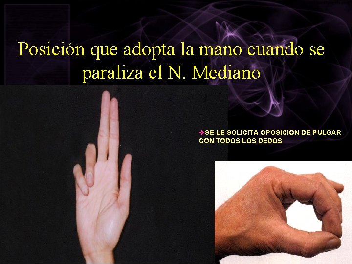 Posición que adopta la mano cuando se paraliza el N. Mediano v. SE LE