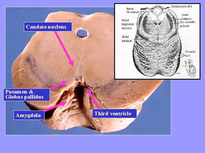 Caudate nucleus Putamen & Globus pallidus Amygdala Third ventricle 