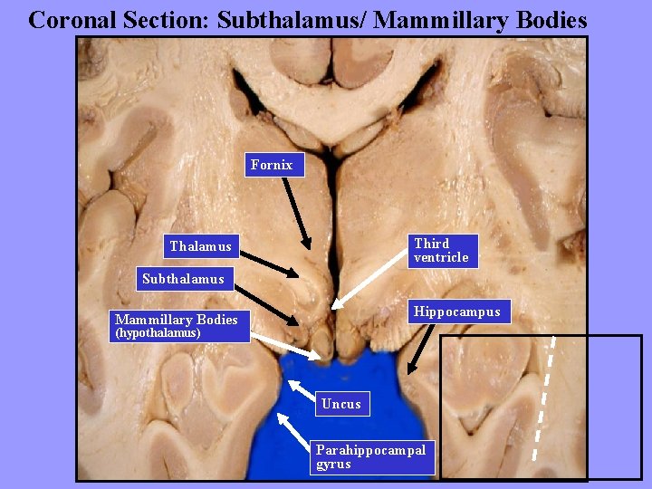 Coronal Section: Subthalamus/ Mammillary Bodies Fornix Third ventricle Thalamus Subthalamus Hippocampus Mammillary Bodies (hypothalamus)