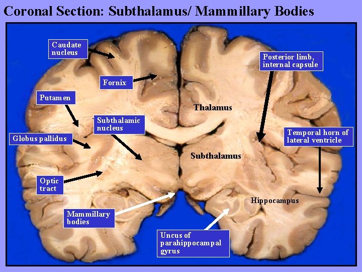 Coronal Section: Subthalamus/ Mammillary Bodies Caudate nucleus Posterior limb, internal capsule Fornix Putamen Thalamus