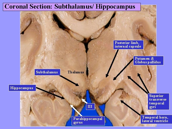 Coronal Section: Subthalamus/ Hippocampus Posterior limb, internal capsule Putamen & Globus pallidus Subthalamus Thalamus