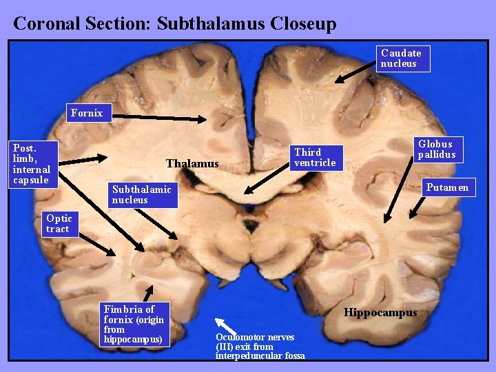 Coronal Section: Subthalamus Closeup Caudate nucleus Fornix Post. limb, internal capsule Thalamus Globus pallidus