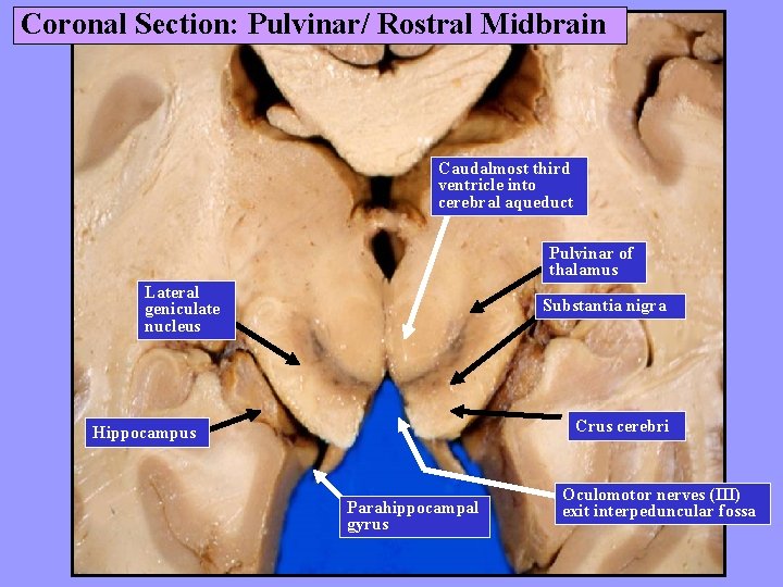 Coronal Section: Pulvinar/ Rostral Midbrain Caudalmost third ventricle into cerebral aqueduct Pulvinar of thalamus