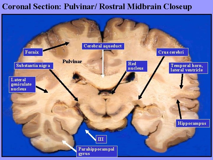 Coronal Section: Pulvinar/ Rostral Midbrain Closeup Cerebral aqueduct Fornix Substantia nigra Crus cerebri Pulvinar