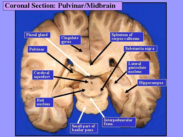 Coronal Section: Pulvinar/Midbrain Pineal gland Cingulate gyrus Splenium of corpus callosum Substantia nigra Pulvinar