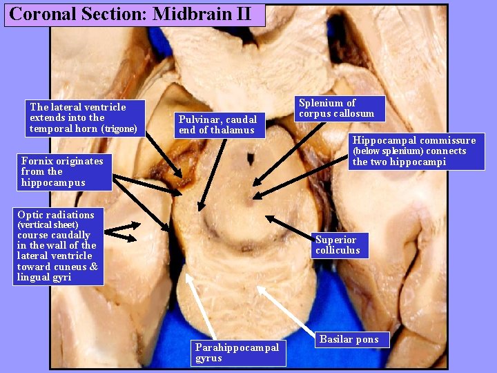 Coronal Section: Midbrain II The lateral ventricle extends into the temporal horn (trigone) Pulvinar,