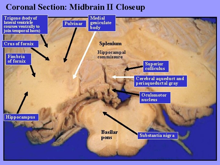 Coronal Section: Midbrain II Closeup Trigone (body of lateral ventricle courses ventrally to join