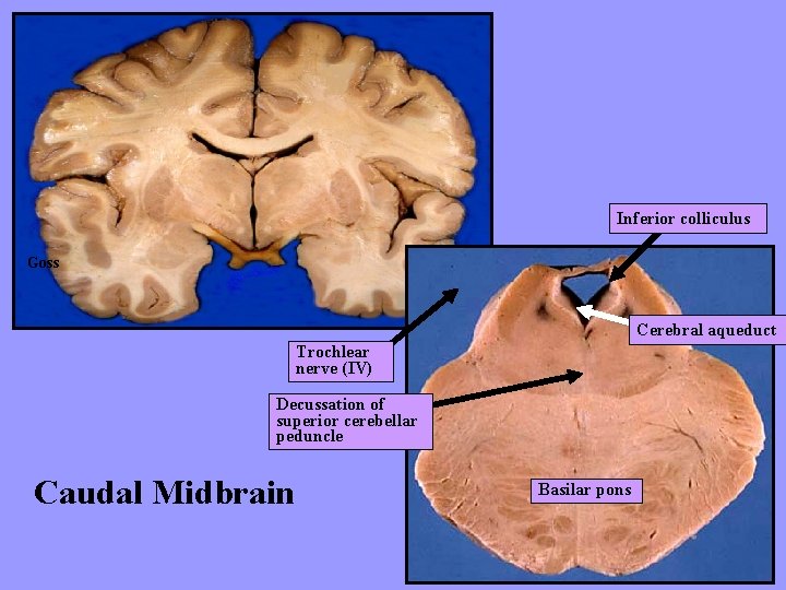 Inferior colliculus Goss Cerebral aqueduct Trochlear nerve (IV) Decussation of superior cerebellar peduncle Caudal
