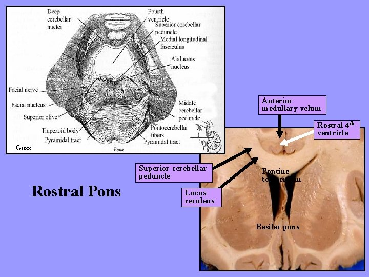 Anterior medullary velum Rostral 4 th ventricle Goss Superior cerebellar peduncle Rostral Pons Pontine