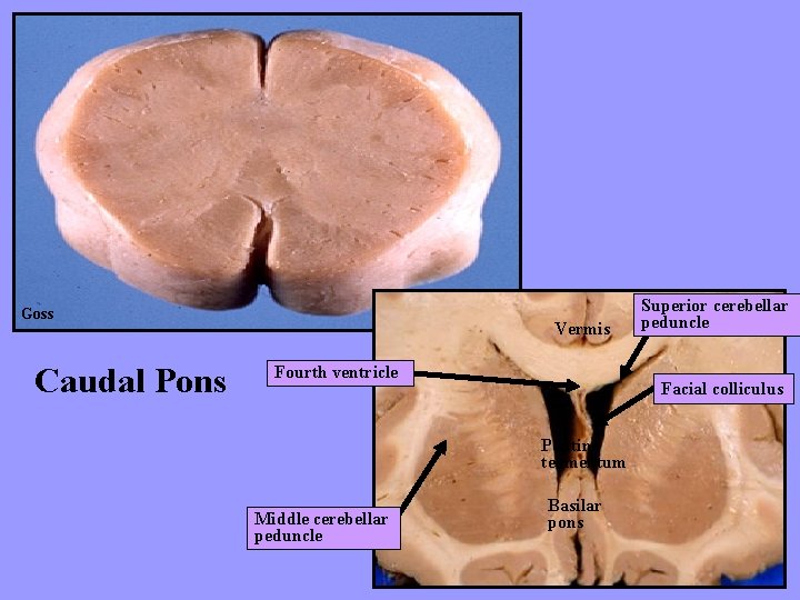 Goss Caudal Pons Vermis Fourth ventricle Facial colliculus Pontine tegmentum Middle cerebellar peduncle Superior