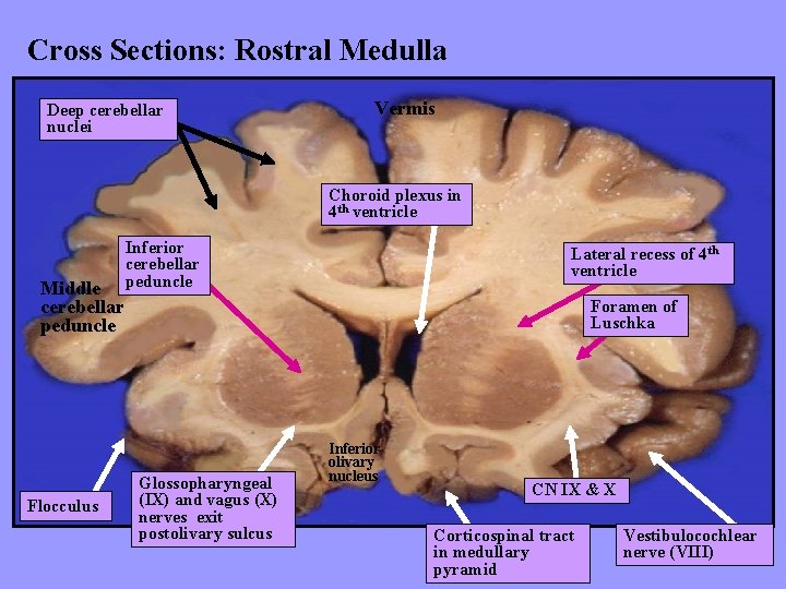 Cross Sections: Rostral Medulla Deep cerebellar nuclei Vermis Choroid plexus in 4 th ventricle