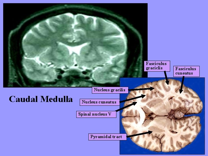 Fasciculus graciclis Goss Nucleus gracilis Caudal Medulla Nucleus cuneatus Spinal nucleus V Pyramidal tract