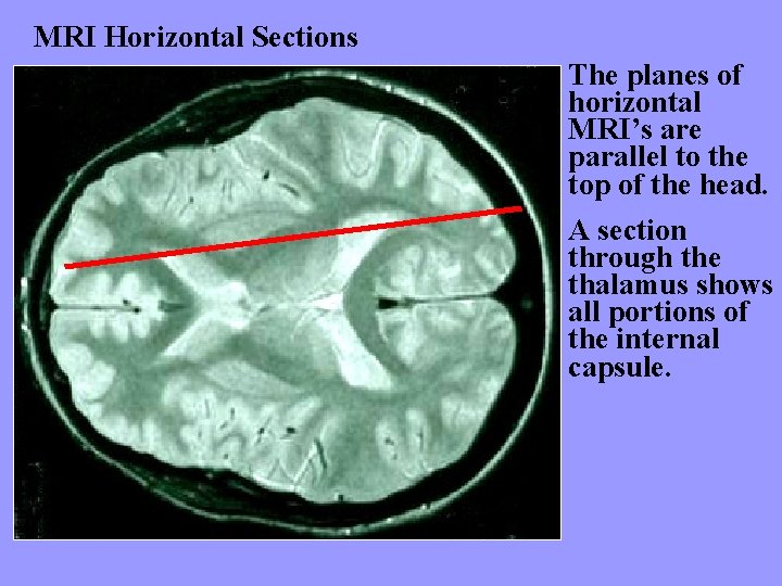 MRI Horizontal Sections The planes of horizontal MRI’s are parallel to the top of