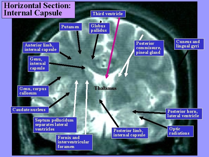 Horizontal Section: Internal Capsule Putamen Third ventricle Globus pallidus Posterior commissure, pineal gland Anterior
