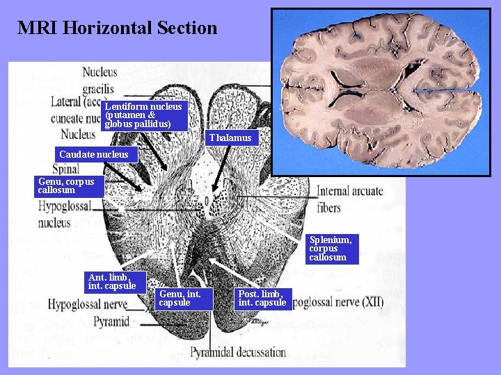 MRI Horizontal Section T 2 Lentiform nucleus (putamen & globus pallidus) Thalamus Caudate nucleus