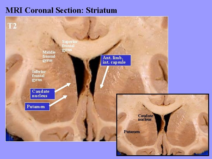MRI Coronal Section: Striatum T 2 Middle frontal gyrus Superior frontal gyrus Ant. limb,