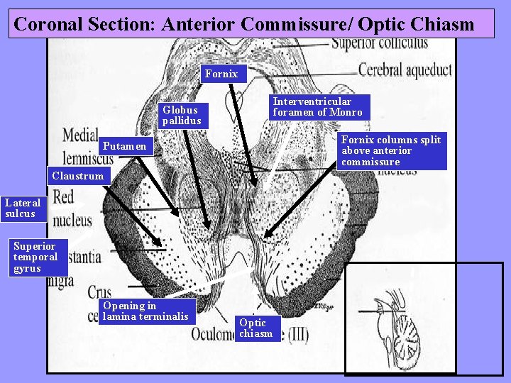 Coronal Section: Anterior Commissure/ Optic Chiasm Fornix Interventricular foramen of Monro Globus pallidus Fornix