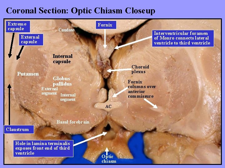 Coronal Section: Optic Chiasm Closeup Extreme capsule Fornix Caudate Interventricular foramen of Monro connects