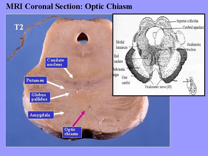 MRI Coronal Section: Optic Chiasm T 2 Caudate nucleus Putamen Globus pallidus Amygdala Optic