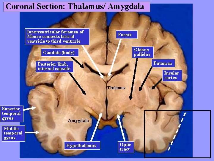 Coronal Section: Thalamus/ Amygdala Interventricular foramen of Monro connects lateral ventricle to third ventricle