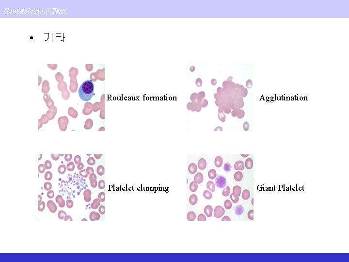 Hematological Tests • 기타 Rouleaux formation Platelet clumping Agglutination Giant Platelet 