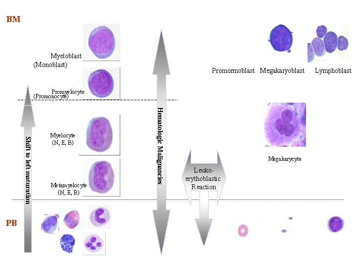 BM Myeloblast (Monoblast) Promormoblast Megakaryoblast Promyelocyte (Promonocyte) Metamyelocyte (N, E, B) Hematologic Malignancies Shift