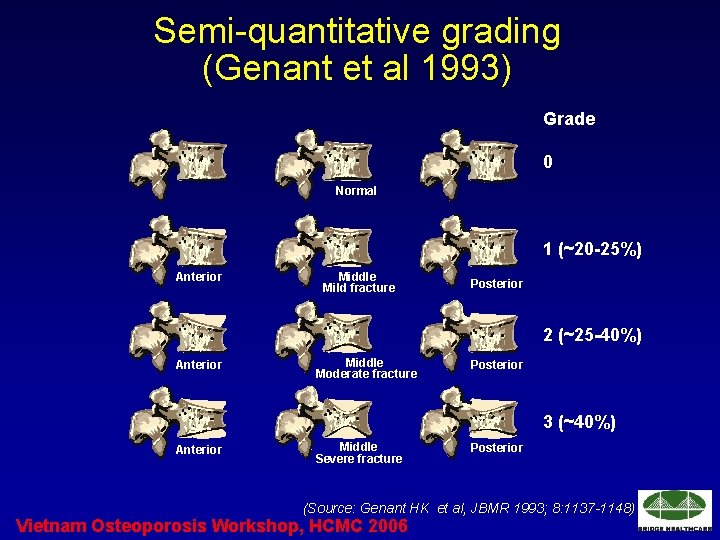 Semi-quantitative grading (Genant et al 1993) Grade 0 Normal 1 (~20 -25%) Anterior Middle