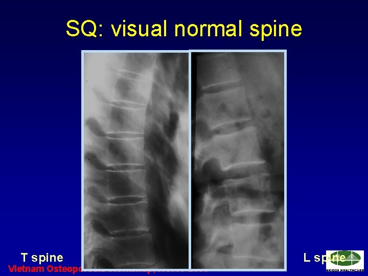 SQ: visual normal spine T spine Vietnam Osteoporosis Workshop, HCMC 2006 L spine 