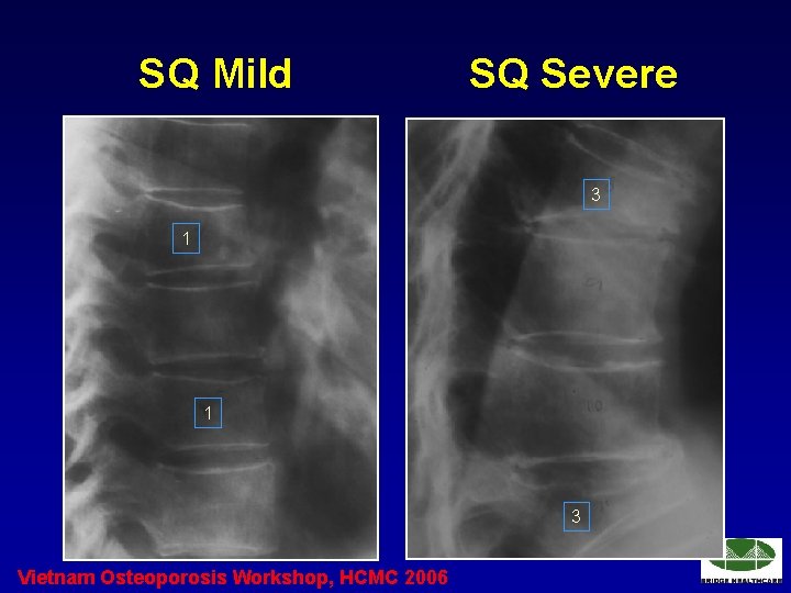 SQ Mild SQ Severe 3 1 1 3 Vietnam Osteoporosis Workshop, HCMC 2006 