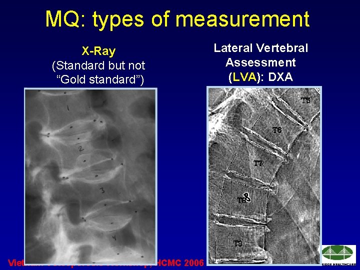 MQ: types of measurement X-Ray (Standard but not “Gold standard”) Vietnam Osteoporosis Workshop, HCMC