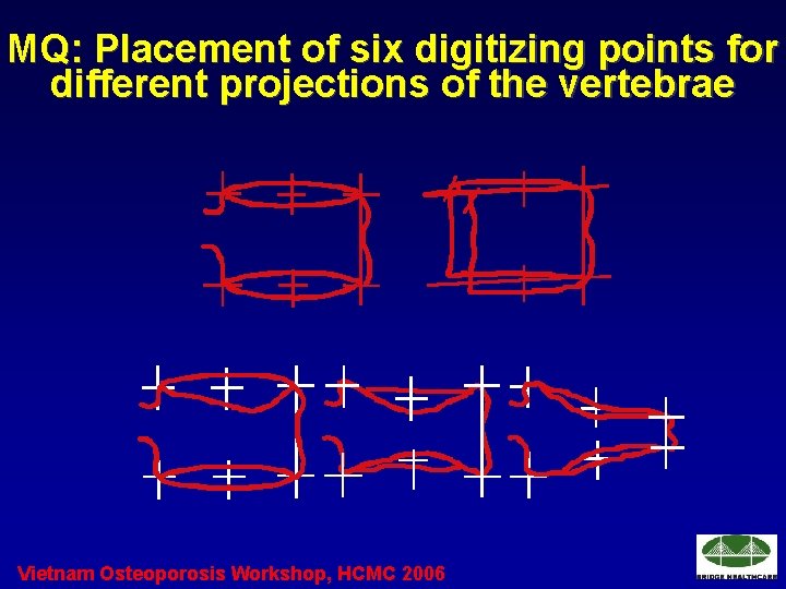 MQ: Placement of six digitizing points for different projections of the vertebrae Vietnam Osteoporosis