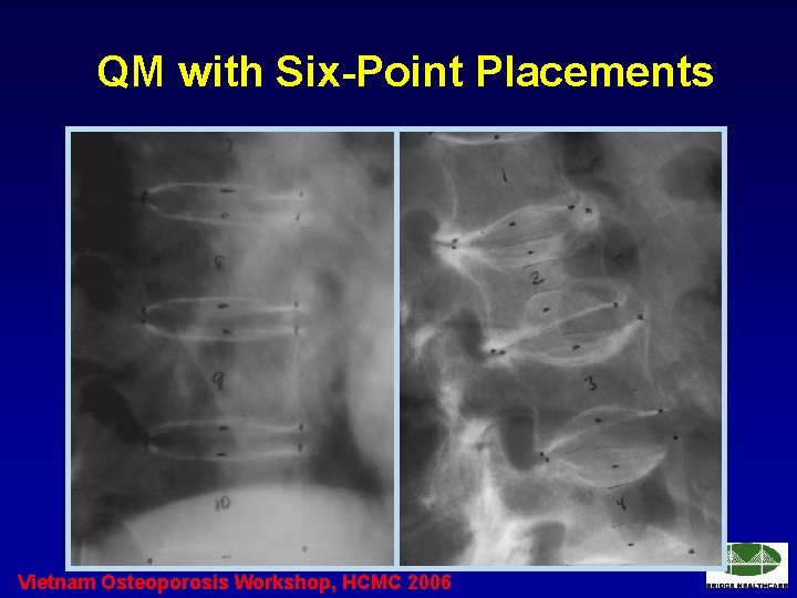 QM with Six-Point Placements Vietnam Osteoporosis Workshop, HCMC 2006 