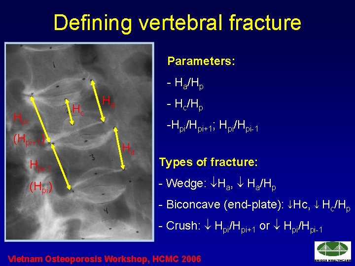 Defining vertebral fracture Parameters: - Ha/Hp Hc Hpi (Hpi+1) Ha - Hc/Hp -Hpi/Hpi+1; Hpi/Hpi-1