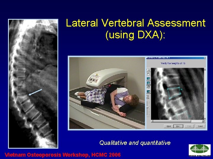 Lateral Vertebral Assessment (using DXA): Qualitative and quantitative Vietnam Osteoporosis Workshop, HCMC 2006 