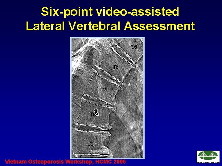 Six-point video-assisted Lateral Vertebral Assessment Vietnam Osteoporosis Workshop, HCMC 2006 