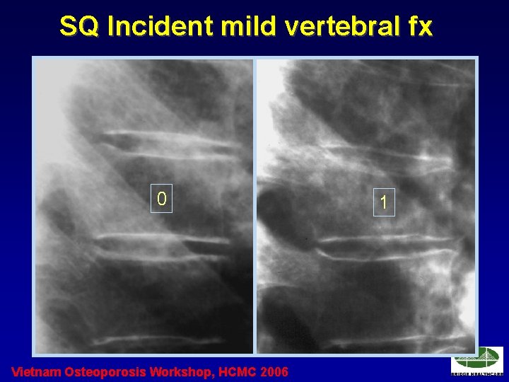 SQ Incident mild vertebral fx 0 Vietnam Osteoporosis Workshop, HCMC 2006 1 