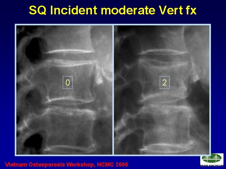 SQ Incident moderate Vert fx 0 Vietnam Osteoporosis Workshop, HCMC 2006 2 