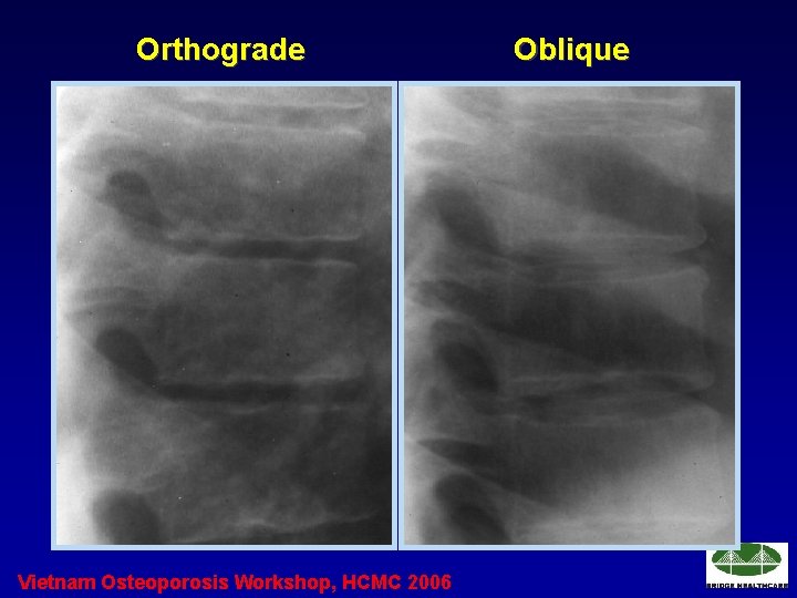 Orthograde Vietnam Osteoporosis Workshop, HCMC 2006 Oblique 