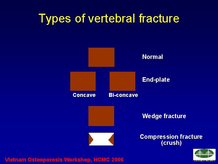 Types of vertebral fracture Normal End-plate Concave Bi-concave Wedge fracture Compression fracture (crush) Vietnam