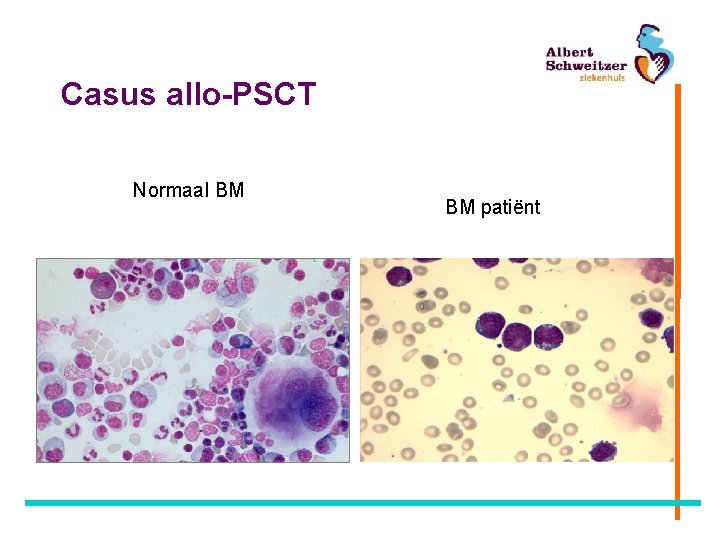 Casus allo-PSCT Normaal BM BM patiënt 