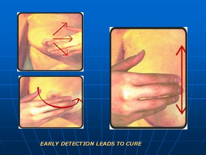 EARLY DETECTION LEADS TO CURE 