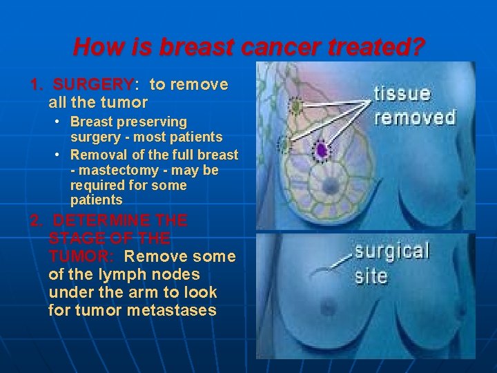 How is breast cancer treated? 1. SURGERY: to remove all the tumor • Breast