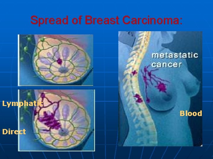 Spread of Breast Carcinoma: Lymphatic Blood Direct 