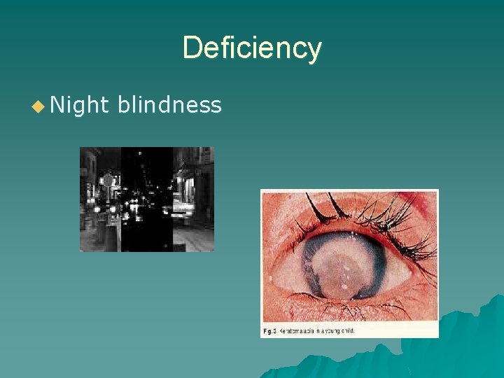 Deficiency u Night blindness 